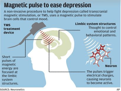 estimulación magnética neuronal