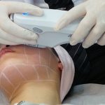 Ultrasonido HiFu
