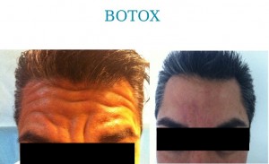 BOTOX1