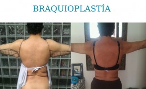 BRAQUIPLASTÍAFINAL